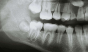 OPG-x-rays768x452